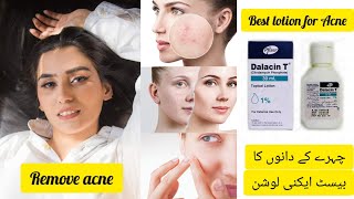 Best Acne Lotion  Dalacin T Lotion  Calindamycin 1 Acne Lotion Review [upl. by Ahsiemac631]