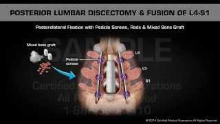 Posterior Lumbar Discectomy amp Fusion of L4S1 [upl. by Melise]