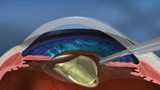 Options in Laser Eye Surgery  LASIK  Contoura Vision or Customized Lasik  PRK  FEMTO  SMILE [upl. by Myrta490]