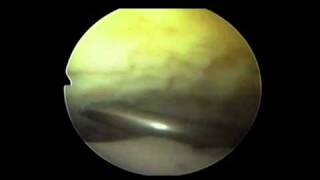 Performing an Arthroscopic Ankle Arthrodesis Surgery  Simon Moyes Capital Orthopaedics [upl. by Marshal]