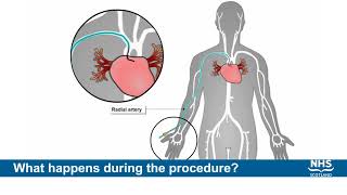 Heart Bypass Surgery CABG [upl. by Nanek896]