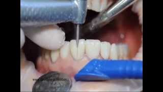 Procera veneers removal [upl. by Heidie]