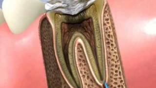 Traitement canal dentaire et pose dun inlaycore [upl. by Nirda]