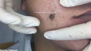 Removing Years Old Blackheads On a Mans Face Easily SS01E01 [upl. by Akcirre]