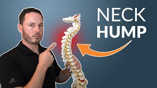 How To Correct Your NECK HUMP  Simple Stretch amp Exercise [upl. by Servetnick]