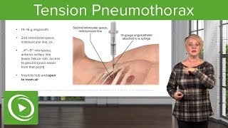 Tension Pneumothorax EMERGENCY Dont Miss This Crucial Diagnosis [upl. by Aillil]