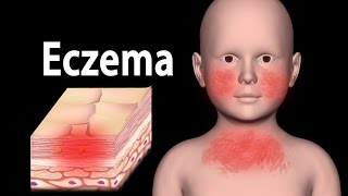 Eczema Animation [upl. by Rillis]