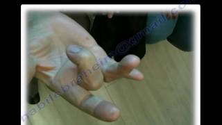 Trigger Finger  Thumb All you need to know [upl. by Ajaj605]