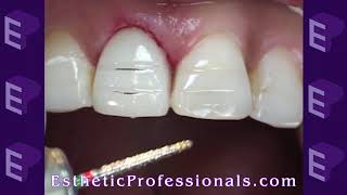 Porcelain Veneers Preparation Techniques 1 [upl. by Yesdnik]