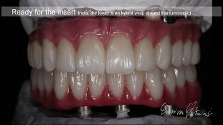 Zirconia Monolithic Full Implant Bridge Tutorial [upl. by Ann-Marie866]