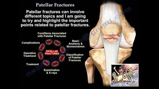 Fracture Femur Types  Everything You Need To Know  Dr Nabil Ebraheim [upl. by Alisander]