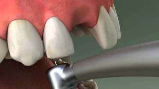 Dentist  Maryland Bridge Procedure [upl. by Randolph179]