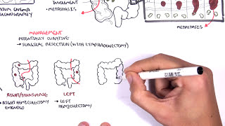 Colorectal Cancer  Overview [upl. by Zurn798]