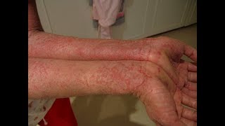 Treatment of eczema and other skin diseases [upl. by Bara895]