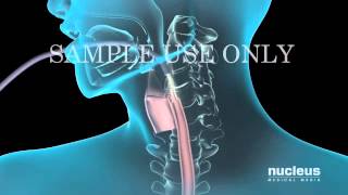 Upper Gastrointestinal Endoscopy EGD [upl. by Junette]