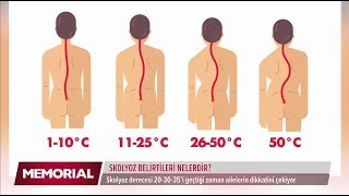 Skolyoz belirtileri nelerdir  Prof Dr Emre Acaroğlu Ortopedi ve Travmatoloji Uzmanı [upl. by Aneetsirhc]