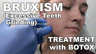 Teeth Grinding Bruxism Treatment with Botox  Dr Paul Ruff  West End Plastic Surgery [upl. by Eram579]