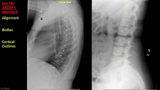 Introduction to Spine Radiographs [upl. by Deery]