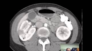 CT Kidneys and Bladder  Five pathologic cases discussed [upl. by Ovatsug]