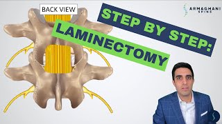 Step by step how to perform a lumbar laminectomy [upl. by Nilved]