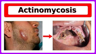 actinomycosis [upl. by Hastie299]