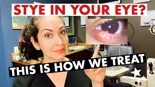 STYES  What are they and how are they treated  The Eye Surgeon [upl. by Sonitnatsnoc]