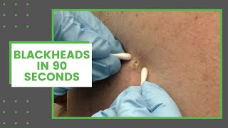 Blackheads in 90 Seconds  Dr Derm [upl. by Pegma]