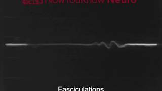 EMG Fasciculations [upl. by Lorinda]