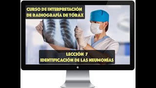 CURSO DE INTERPRETACIÓN RADIOGRAFÍA DE TÓRAX IDENTIFICACIÓN RADIOLÓGICA DE LAS NEUMONÍAS [upl. by Schinica]