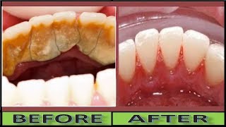 How to Remove TARTAR and Plaque in 3 Minutes Without Scaling Natural WHITE TEETH [upl. by Ias]