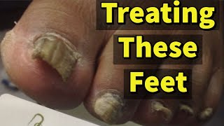 Treating These Feet A Patient With Fungal Toenails [upl. by Losiram]