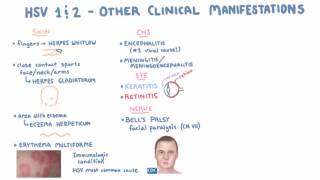 HSV  Clinical Presentation  Part 2 [upl. by Docile]