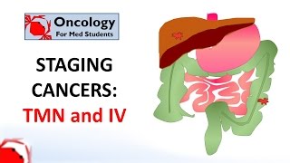 The Staging and Grading of Cancer [upl. by Ferna]