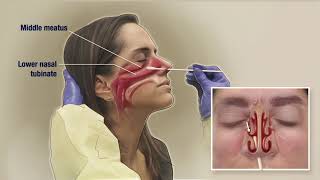 How To Use Nasal Spray  How To Use Nasal Spray Properly  Nasal Spray Technique 2018 [upl. by Holbrook]