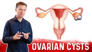 Ovarian Cysts Causes Symptoms amp Natural Treatment – DrBerg [upl. by Ahsilam]