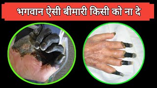 एक एसी खतरनाक बीमारी  Gangrene Symptoms and causes  gangrene kyu hota hai  Dr tarun [upl. by Ihc164]