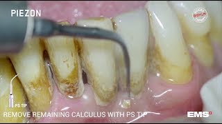 Guided Biofilm Therapy Step 06 Calculus removal with PIEZON® and the PS instrument [upl. by Ueihttam469]