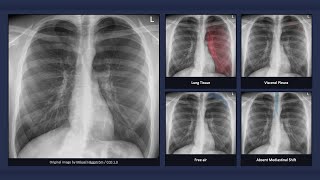 Simple Pneumothorax Explanation of Chest Xray Findings [upl. by Kai]