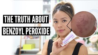 Clear Acne With Benzoyl Peroxide Pros and Cons [upl. by Hayott]