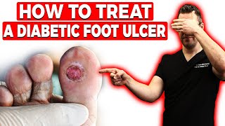 Outer Foot Pain with Plantar Fasciitis [upl. by Ozzy]