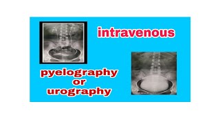 Intravenous Pyelography  Urography IVP  IVU [upl. by Inihor982]