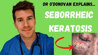 Explaining Seborrheic Keratosis  With Dr ODonovan [upl. by Tsiuqram]