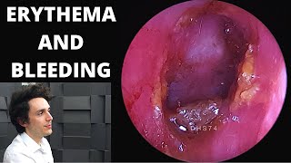 Draining of Massive Ear Hematoma Cauliflower Ear [upl. by Reena]