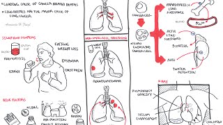 Lung Cancer  Overview [upl. by Dlanigger]