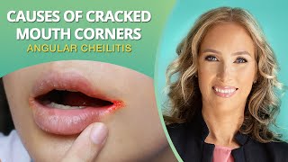 What Causes Mouth Corner Cracks  Angular Cheilitis  Dr J9 Live [upl. by Lipman]