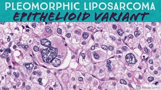 Pleomorphic Liposarcoma Epithelioid Variant [upl. by Elamaj]