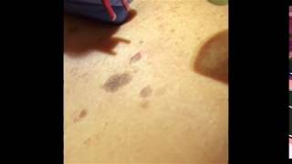 Treatment of Seborrheic Keratosis [upl. by Tobit455]