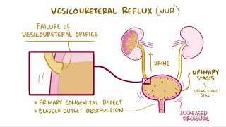 VIDEO Acute pyelonephritis urinary tract infection causes symptoms amp pathology [upl. by Yates]