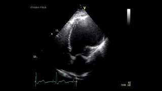 LEFT VENTRICULAR ANEURYSM  ECHOCARDIOGRAPHY [upl. by Homans707]