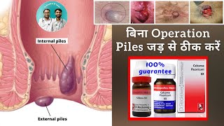 homeopathic medicine for piles piles without pain burning bleeding  piles cure without operation [upl. by Nosduj410]